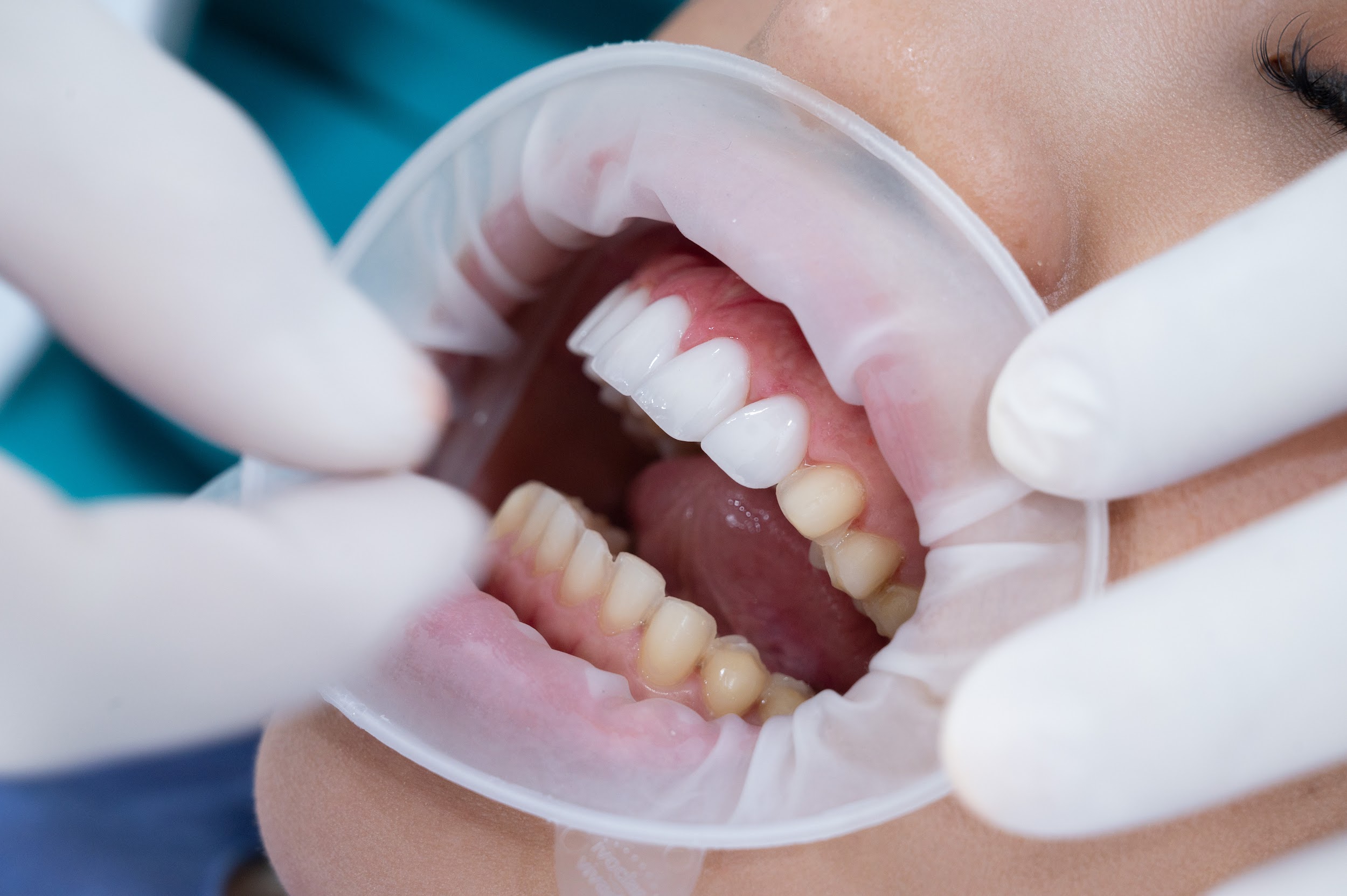 Răng sứ veneer phiên bản 0.3mm: Xu hướng thẩm mỹ răng gây sốt 2023